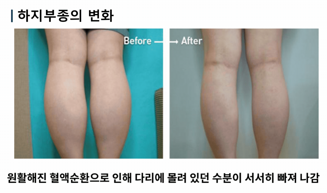 하지부종 전후 변화