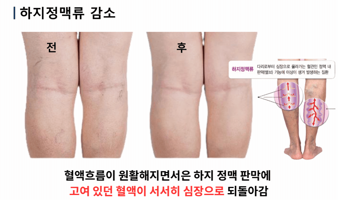 하지정맥 순환 전후 변화